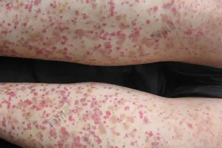 轻度过敏性紫癜图片_有来医生