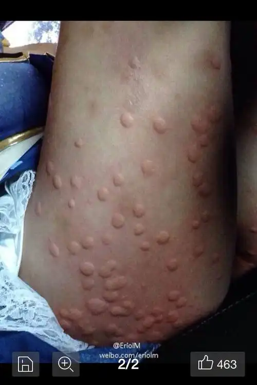 看看这张蚊子包有感觉没