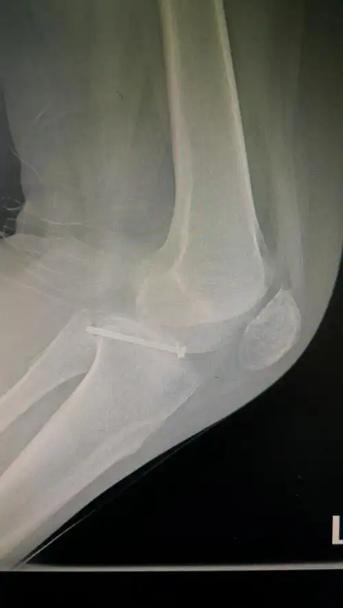 胫骨平台髁间脊骨折病例201811 - 好大夫在线