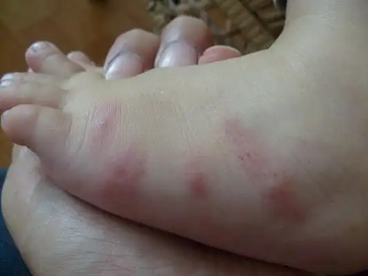 季节性荨麻疹47