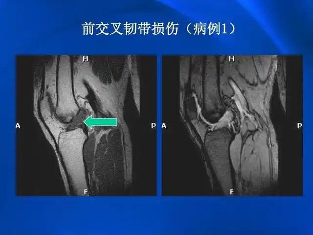 髌骨纵向骨折容易误诊为股骨髁间骨折,且髌骨外侧片内外重叠