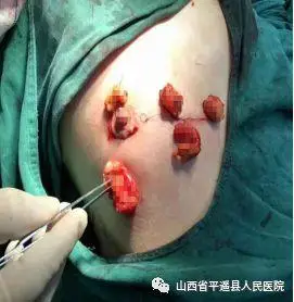 【小手术,大效果】乳腺肿物切除术,将癌消灭在萌芽里!_乳房