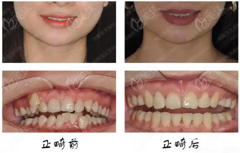 成都圣贝牙科顾客牙齿矫正前后对比图