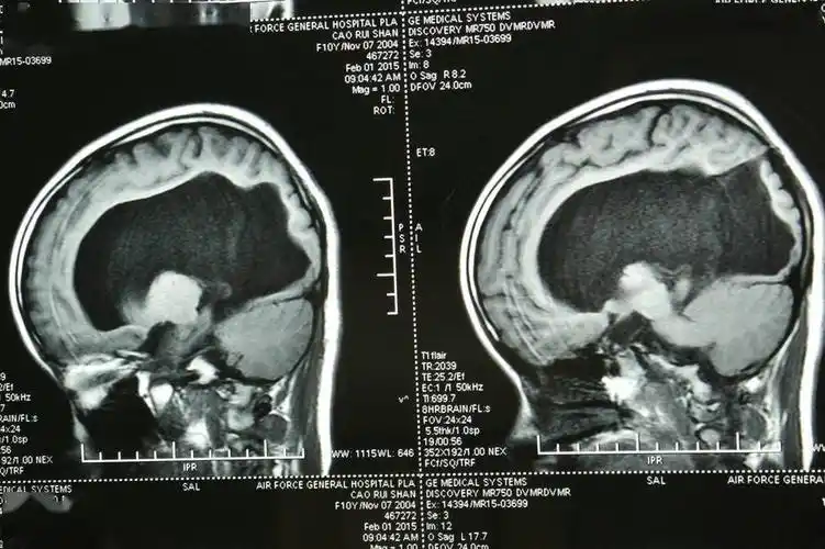 脑积水诊治_脑室