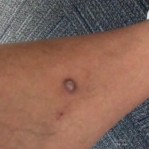 腿上长纤维瘤 要割掉 哪个医院好 就附近找个三甲可以吗