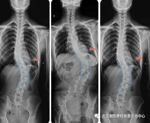 脊柱侧凸唤醒月 | 脊柱侧凸锻炼操,该怎么做才好?