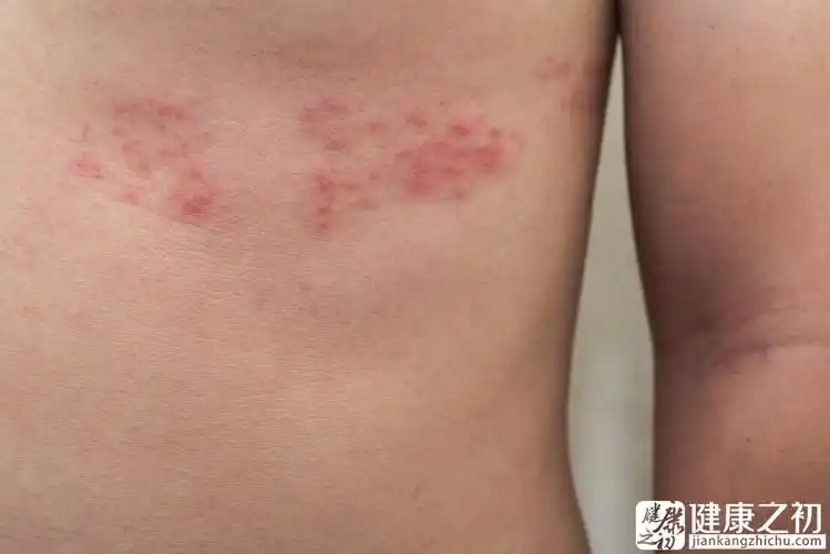病变以沿周围神经分布的群集疱疹和神经痛为特征,其传播途径仍为"皮肤
