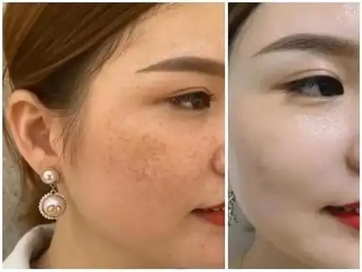 小气泡美容对于脸部皮肤来说并不会有什么明显效果,但是它能够去除