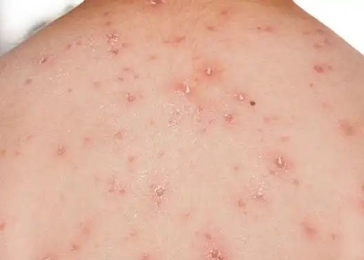 医生提醒hpv来临前身体会有3个提示音速查hpv