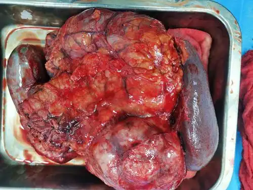 写美篇     胰腺肿瘤是消化道常见的恶性肿瘤之一,是恶性肿瘤中最常见