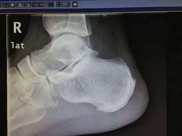 跟痛症(跟骨骨刺,跖腱膜炎)的微创手术治疗