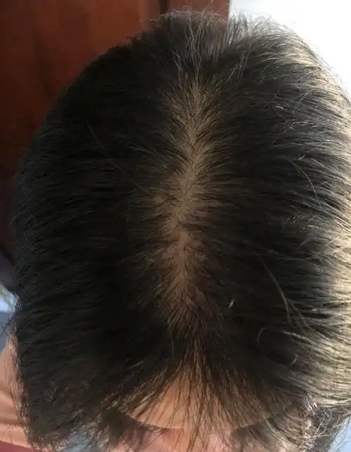 头发稀少怎么办(女生头发稀少怎么办)