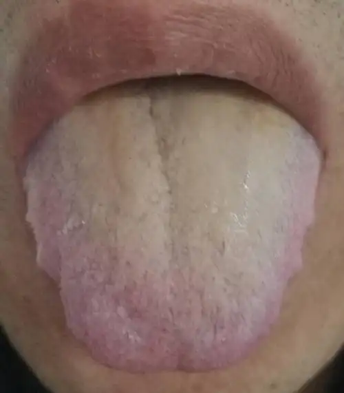 可怕的肾虚,从舌头就能看出来