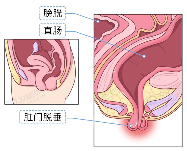 从肛门垂脱向外翻出的一种疾病肛管,直肠(严重时乙状结肠也会)简单来