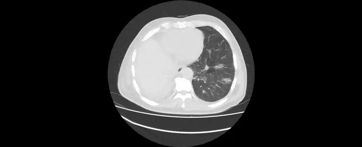 右下肺中央型肺癌