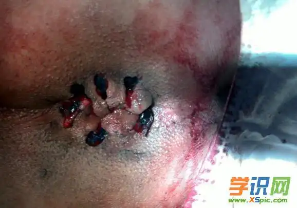 男痔疮的症状图片 男人痣疮图片大全