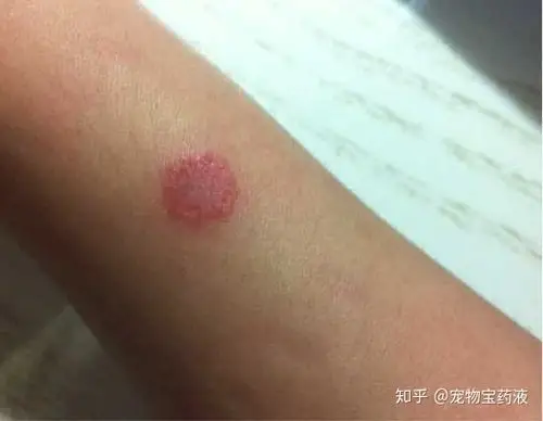 人能得猫癣狗癣吗