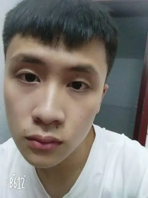 戴了眼镜5年了 眼睛变形很严重 现在想要恢复有方法吗