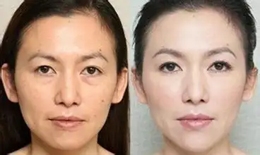 脸部皮肤松弛下垂怎么办