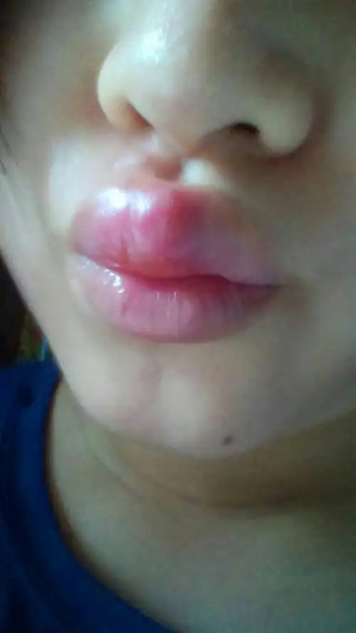 上嘴唇一夜之间起了几个小泡,肿了一点点,第二天早上起来,小泡汇集成