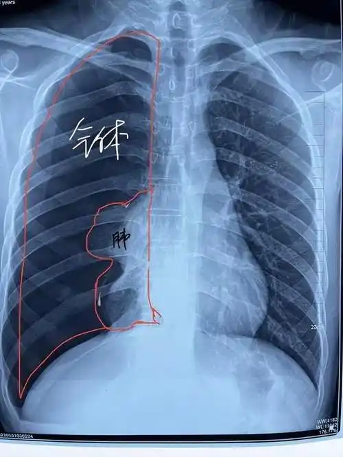 关于气胸你了解多少?_治疗_患者_胸腔
