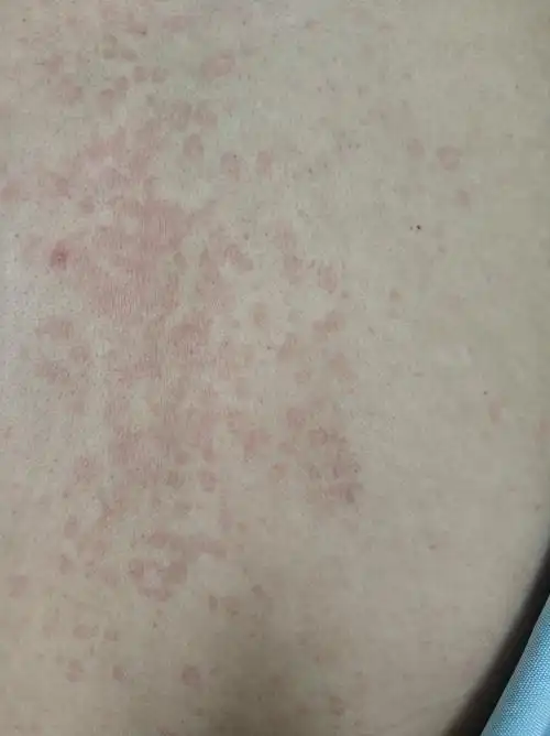 夏季,颈部,胸部,腹部,腋下,背部出现类似皮疹,无症状或微痒,考虑汗斑