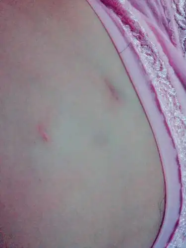 [优生备孕帮]宫外孕做腹腔镜手术的姐妹进来聊一聊