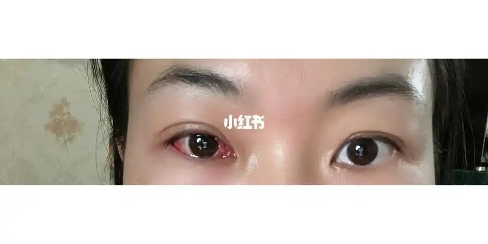 斜视矫正手术拆纱布后第一天