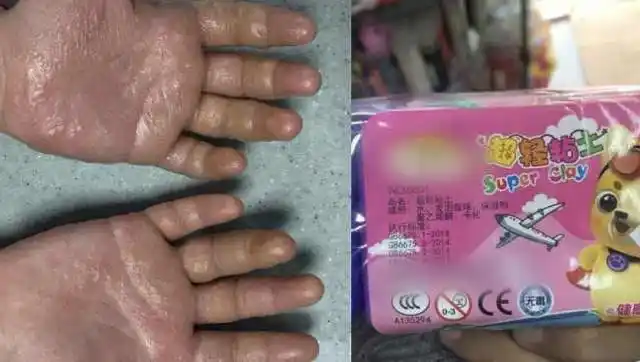 可怕10岁女童玩起泡胶过敏次日手上长满水泡