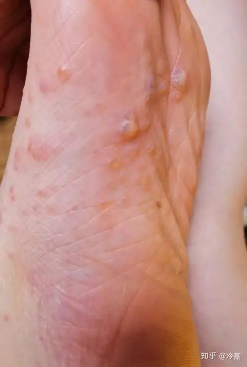 免疫性疾病掌跖脓疱病治疗之路