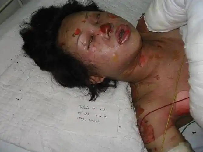 烧伤急救护理ppt 第21页 (共73页,当前第21页) 你可能喜欢 烧伤病人的