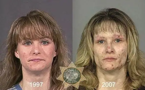 吸毒前后人的容貌对比毒品真是碰不得