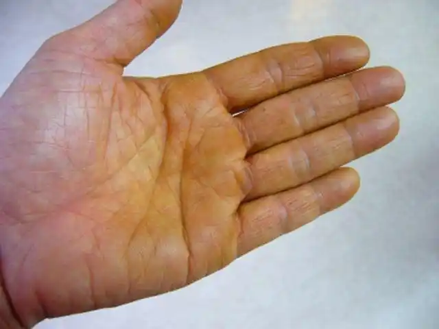 除了肤色之外,舌头,眼睛,指甲和手指都有可能发黄变暗,这就是我们所说