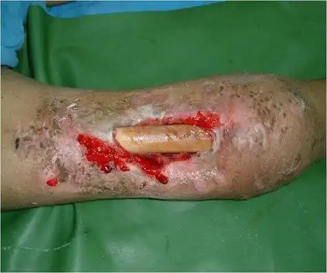 没有脓属于慢性骨髓炎吗