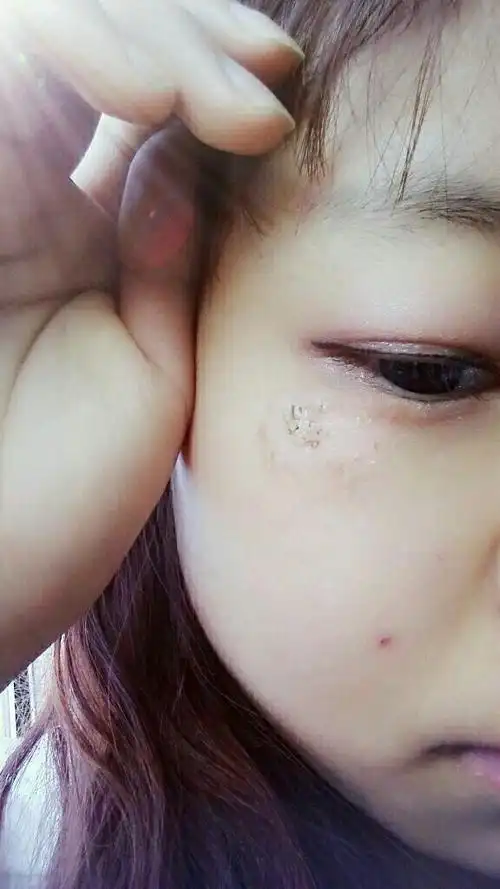 不小心把脸可瞌伤了,都结痂了这样了会不会留疤呢