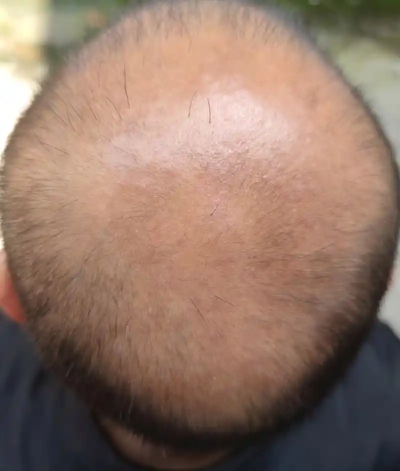 头顶脱发多年又再次生长出头发