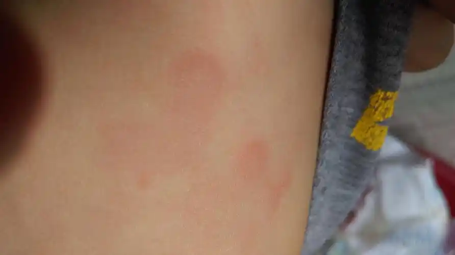 小孩身上出现红色斑,用碘伏洗后可以全愈,但第二天别处又出现.