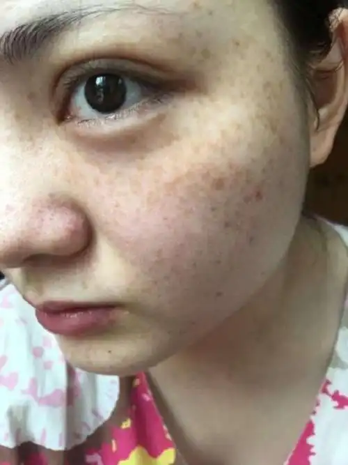 满脸的斑点看着太吓人了01,都说一白遮三丑这脸上的斑_圈子-新氧