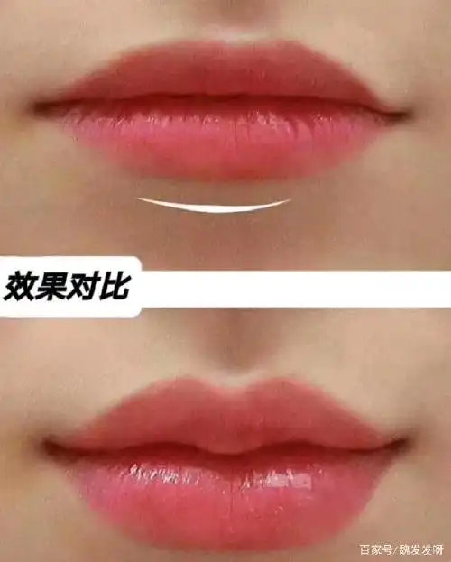 不用手术也能变微笑唇