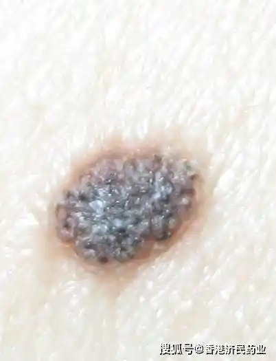 对比4点黑色素瘤与黑痣区分并不难