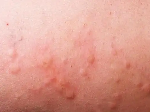 荨麻疹的症状是什么样子的? 荨麻疹的症状是什么样子的图片