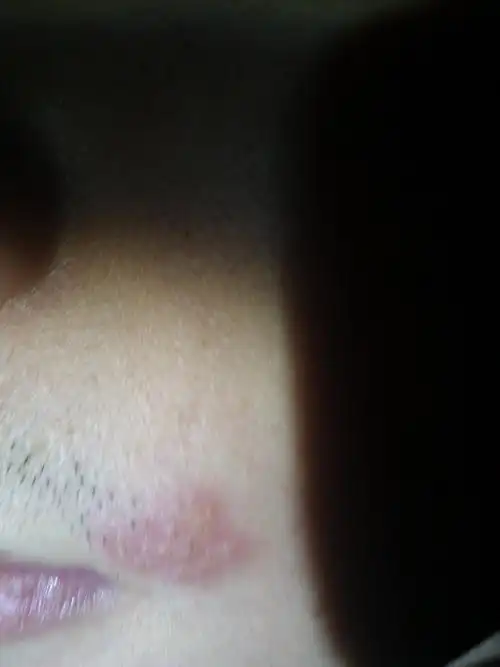 如图是什么皮肤病啊,长在嘴角边.分随便要,只求正确答案