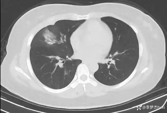 女性30岁,咳嗽,咳痰10天,胸部ct报告肺炎,猜病原体 - 呼吸胸外 - 医学
