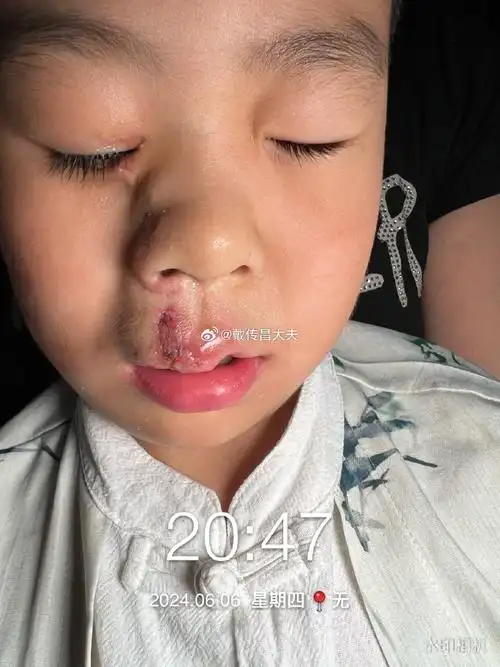 做学龄前完成手术,这位 4 号面裂宝宝,之前找了两位唇裂修复专家修复