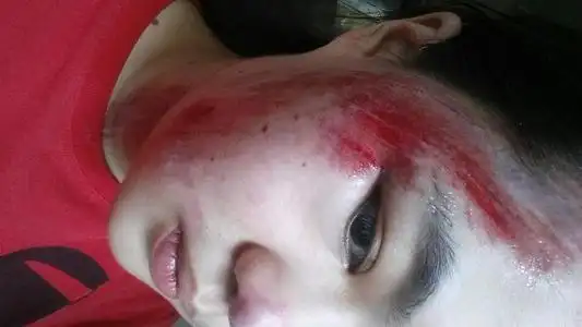 后背擦伤流血图片