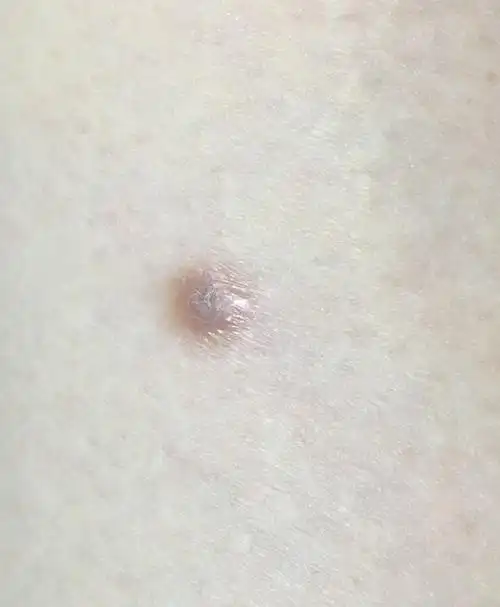 因为皮肤纤维瘤,对健康没有影响,而且也不会恶变.