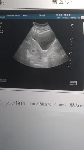 56天 孕囊37mm*24mm*17m 囊内见胚芽长10x7mm, 第一次b超 怀孕47天