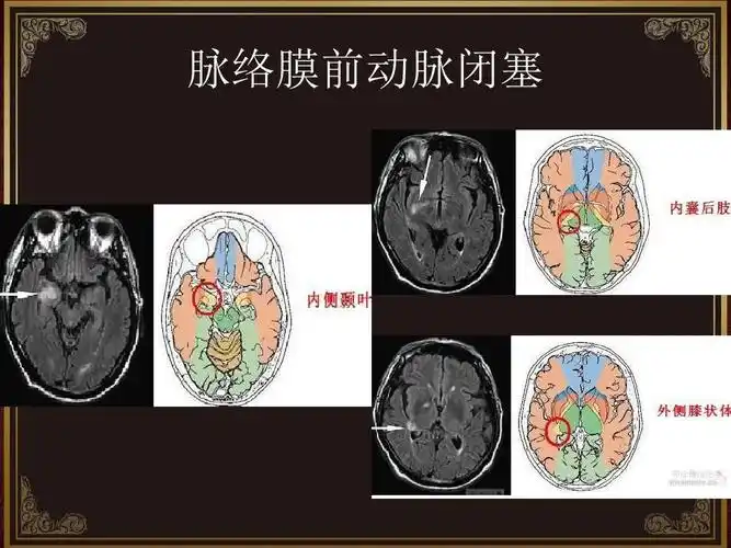 脉络膜前动脉闭塞