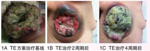 三阴性乳腺癌的mdt诊疗实例