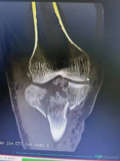 一例复杂的胫骨平台骨折